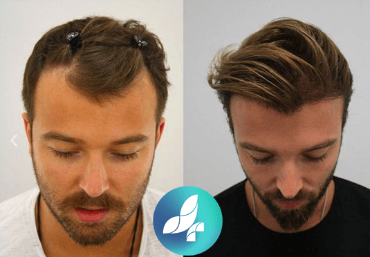 before-after4